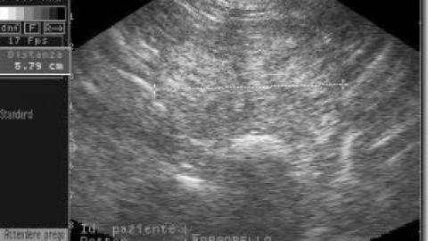 Aspetto Ecografico Patologico della Prostata